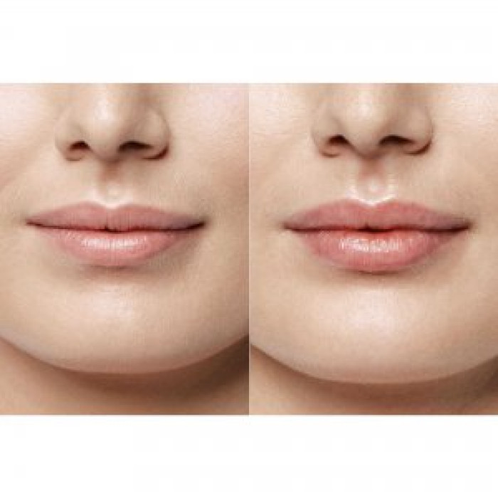 Двухшаговая система для увеличения объема губ SesDerma Fillderma lips